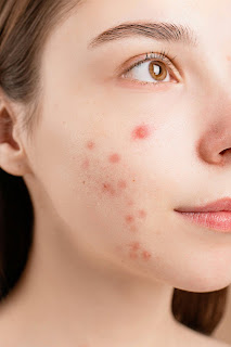 pimples ka gharelu ilaj chehra saaf karne ke tarike
